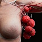 4 Señales Tempranas del Cáncer de Mama que NO Debes Ignorar