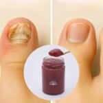 Remedios Efectivos para los Hongos: Naturales y Médicos