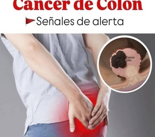 Cáncer de colon: ¿Por qué está aumentando en personas jóvenes?