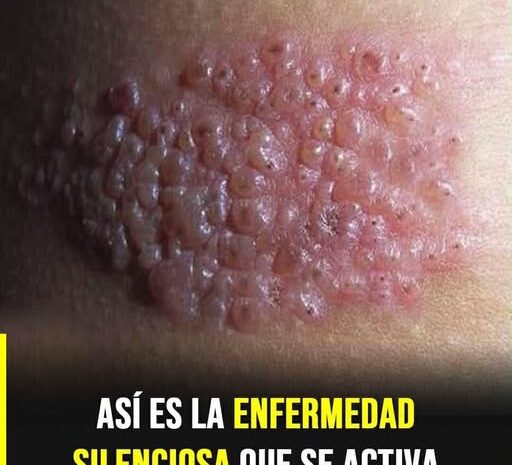 Lo que pocos saben sobre esta enfermedad silenciosa que puede aparecer sin aviso