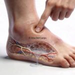 Mira cómo reducir la hinchazón de piernas, caderas y abdomen por retención de líquidos